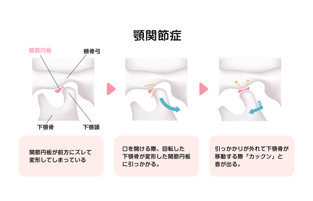 顎関節症のの仕組み