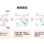 顎関節症のの仕組み