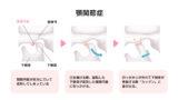 顎関節症のの仕組み