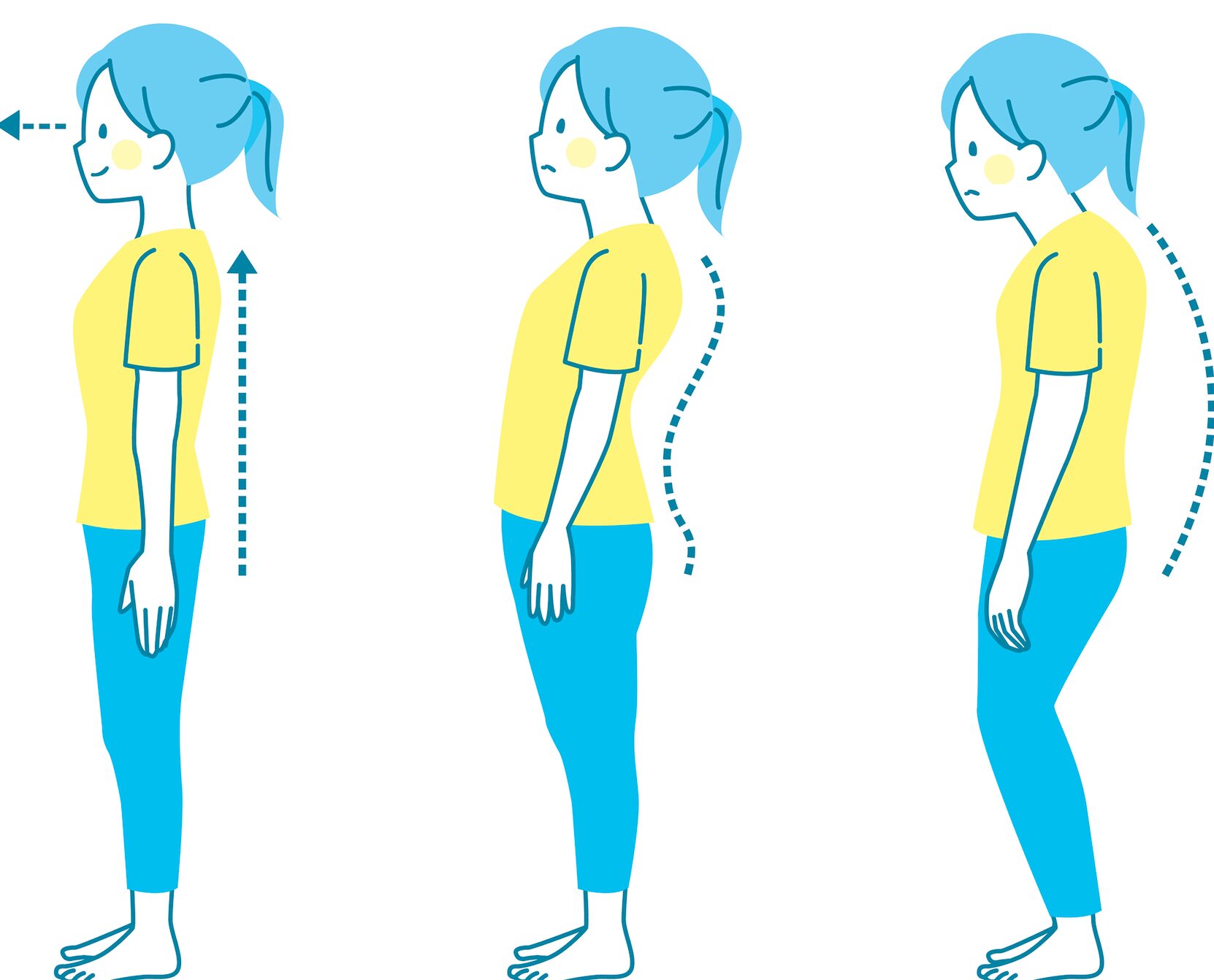 反り腰を含む3つの姿勢を横から見たイラスト。背骨のカーブの違いを比較している